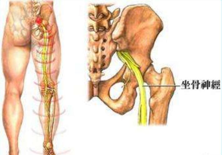 坐骨神经痛会引起背痛胸痛吗,坐骨神经痛的症状会导致背痛吗