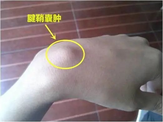 膝盖腱鞘囊肿最快的恢复办法,脚趾腱鞘囊肿会癌变吗