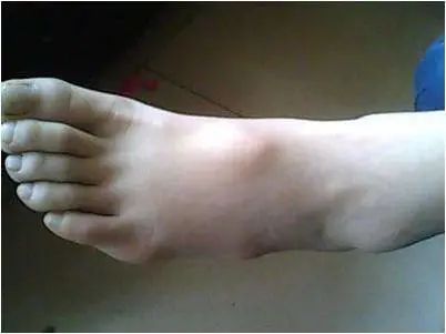 膝盖腱鞘囊肿最快的恢复办法,脚趾腱鞘囊肿会癌变吗