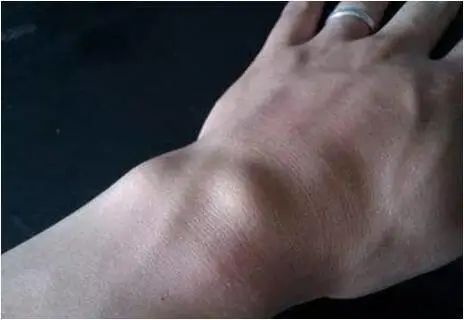 膝盖腱鞘囊肿最快的恢复办法,脚趾腱鞘囊肿会癌变吗