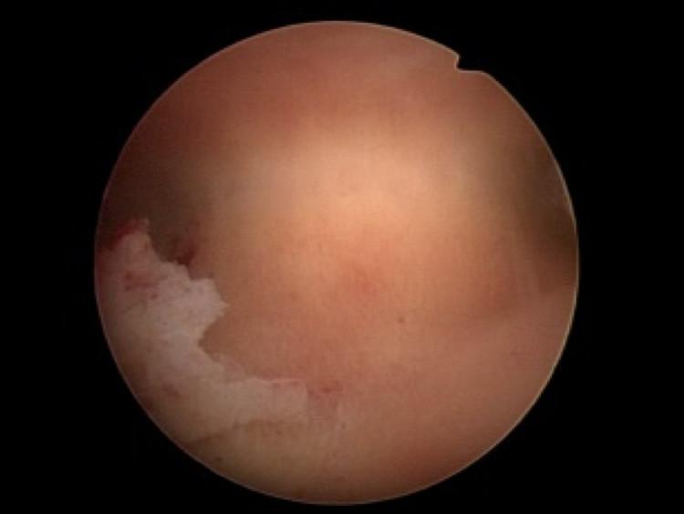 宫腔粘连了还能怀孕吗,宫腔粘连了还能取到卵吗