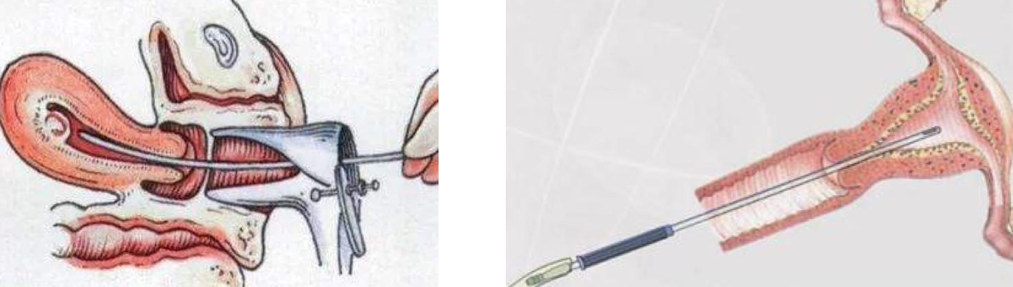 宫腔粘连了还能怀孕吗,宫腔粘连了还能取到卵吗