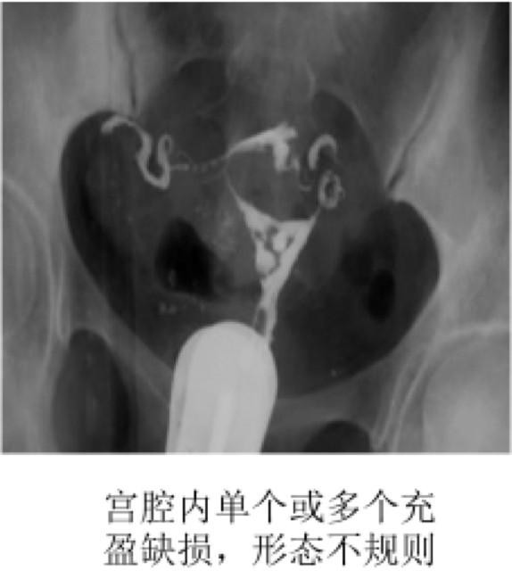 宫腔粘连了还能怀孕吗,宫腔粘连了还能取到卵吗