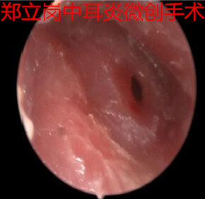 中耳炎手术住院要住多少天,中耳炎穿孔手术大概多少钱