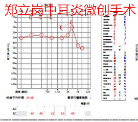 中耳炎手术住院要住多少天,中耳炎穿孔手术大概多少钱
