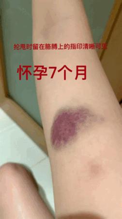 张培萌回应家暴妻子夫妻打架,张培萌妻子谈被家暴