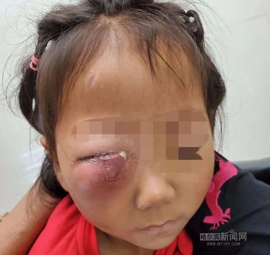 5岁女孩拔完牙被送进icu,15岁女孩误入icu