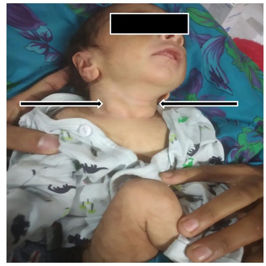 新生儿胸锁乳突肌纤维瘤病