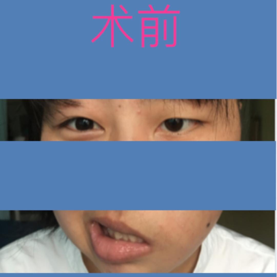 四川华西医院治疗面瘫怎么样,面瘫其实很难治愈