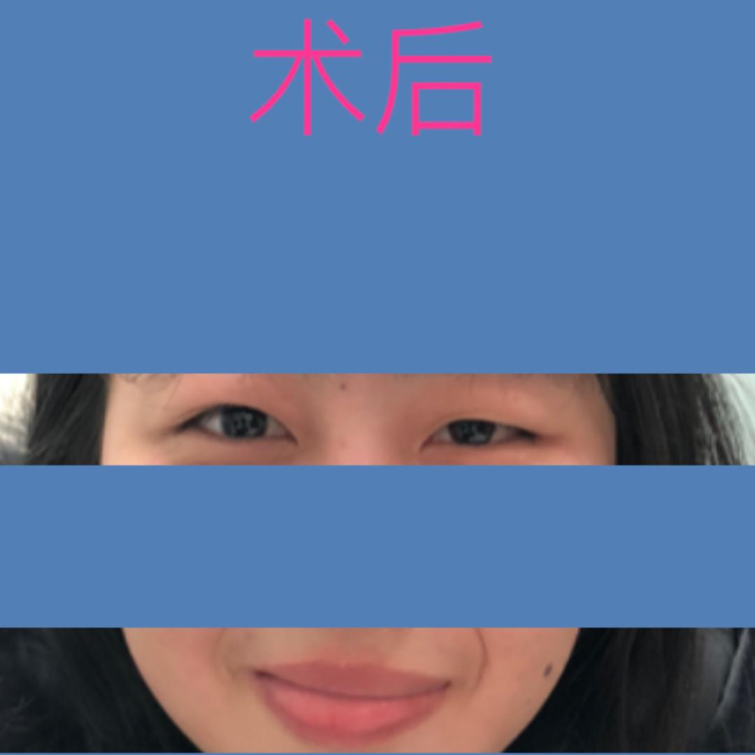 四川华西医院治疗面瘫怎么样,面瘫其实很难治愈