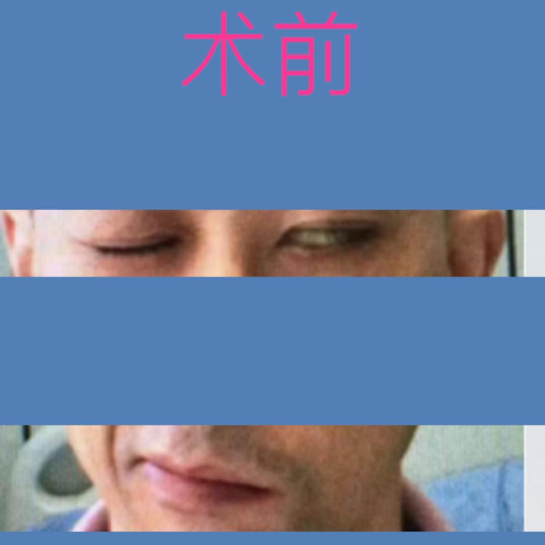 四川华西医院治疗面瘫怎么样,面瘫其实很难治愈