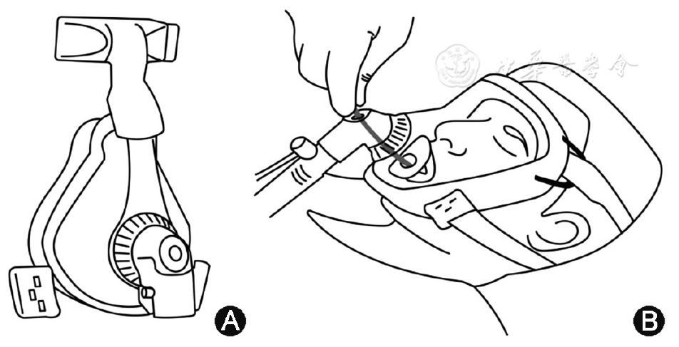 支气管肺泡灌洗术评分标准,肺泡灌洗液涂片检查准确率
