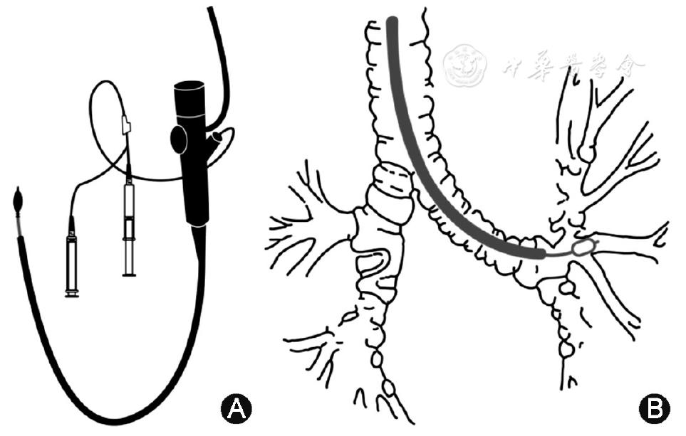 支气管肺泡灌洗术评分标准,肺泡灌洗液涂片检查准确率