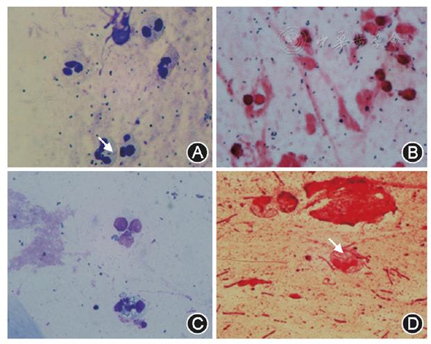 支气管肺泡灌洗术评分标准,肺泡灌洗液涂片检查准确率