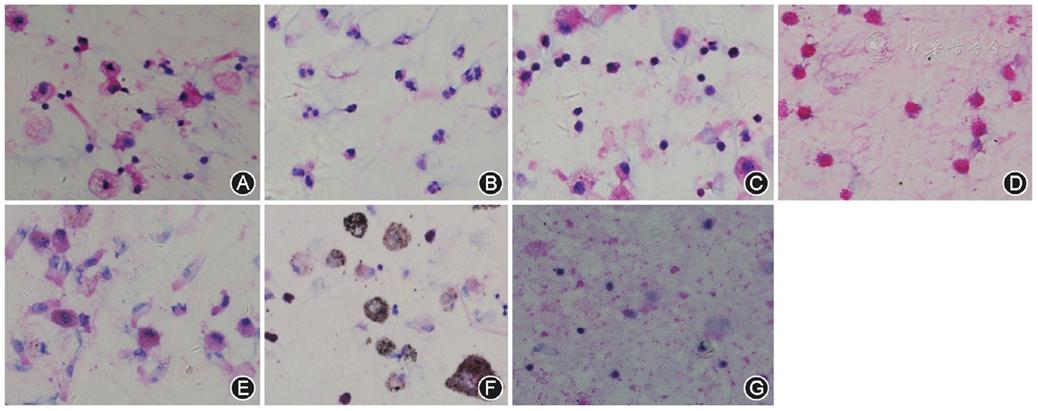 支气管肺泡灌洗术评分标准,肺泡灌洗液涂片检查准确率