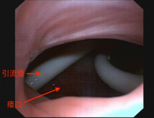 用他自己的肌肉塞进胸腔？甘肃农民为治病跨越大半中国，最终在杭州得救