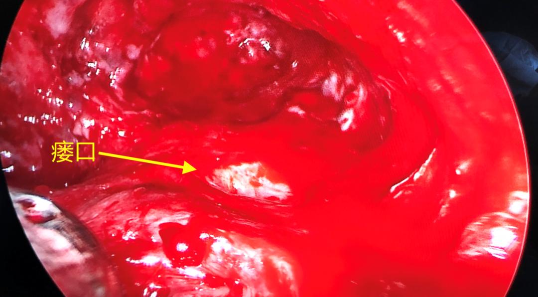 用他自己的肌肉塞进胸腔？甘肃农民为治病跨越大半中国，最终在杭州得救