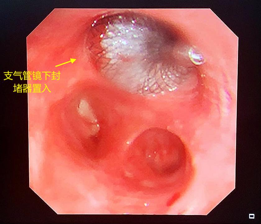 用他自己的肌肉塞进胸腔？甘肃农民为治病跨越大半中国，最终在杭州得救