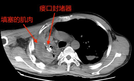 用他自己的肌肉塞进胸腔？甘肃农民为治病跨越大半中国，最终在杭州得救