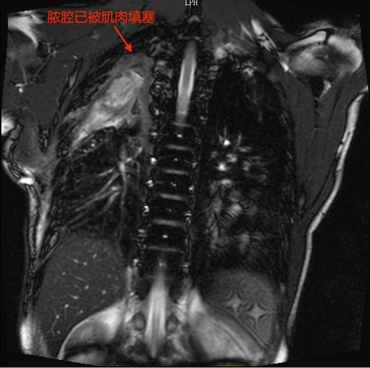 用他自己的肌肉塞进胸腔？甘肃农民为治病跨越大半中国，最终在杭州得救