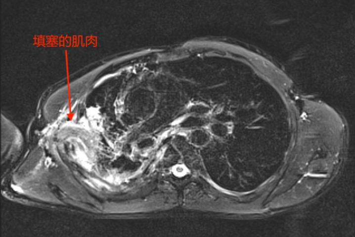 用他自己的肌肉塞进胸腔？甘肃农民为治病跨越大半中国，最终在杭州得救