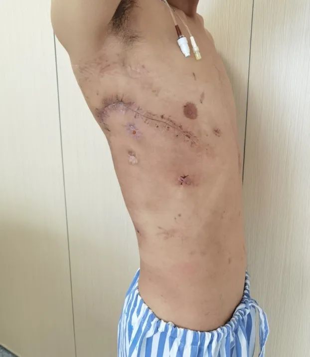 用他自己的肌肉塞进胸腔？甘肃农民为治病跨越大半中国，最终在杭州得救