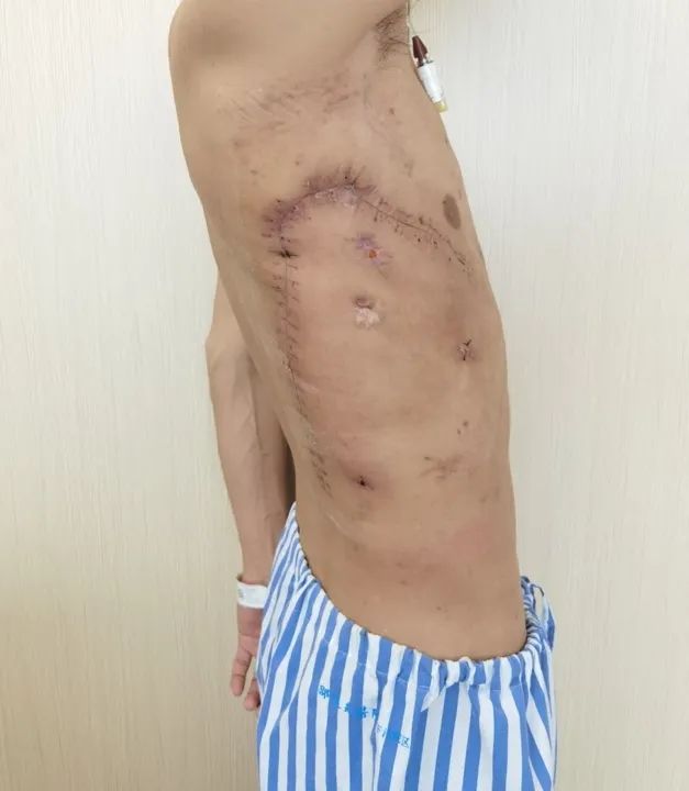 用他自己的肌肉塞进胸腔？甘肃农民为治病跨越大半中国，最终在杭州得救