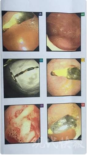 被遗忘在女人体内的「节育环」,该取出来了。