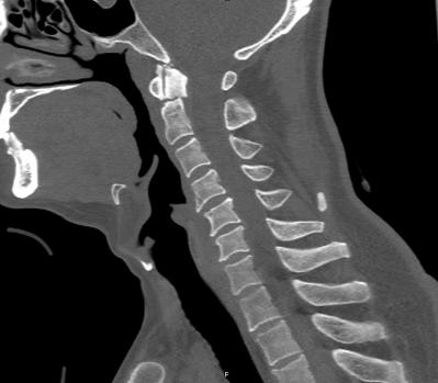北京友谊医院微创外科,北京友谊医院骨科微创手术