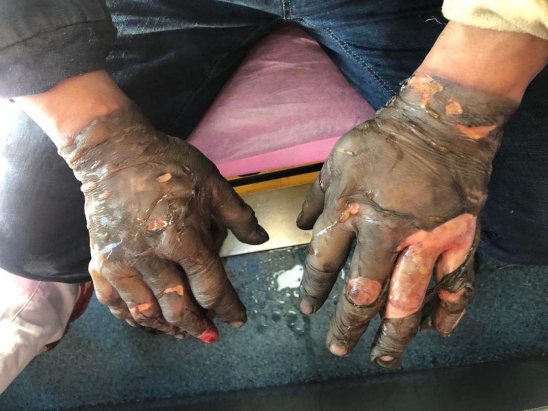 烧伤救治动画视频,快速医疗救援