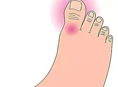 痛风一日三餐食疗方,尿酸高痛风的食疗方