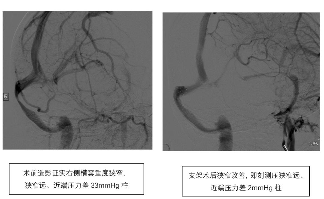 17岁女生头疼突然阶段性失明,19岁眼睛突然失明几分钟后恢复
