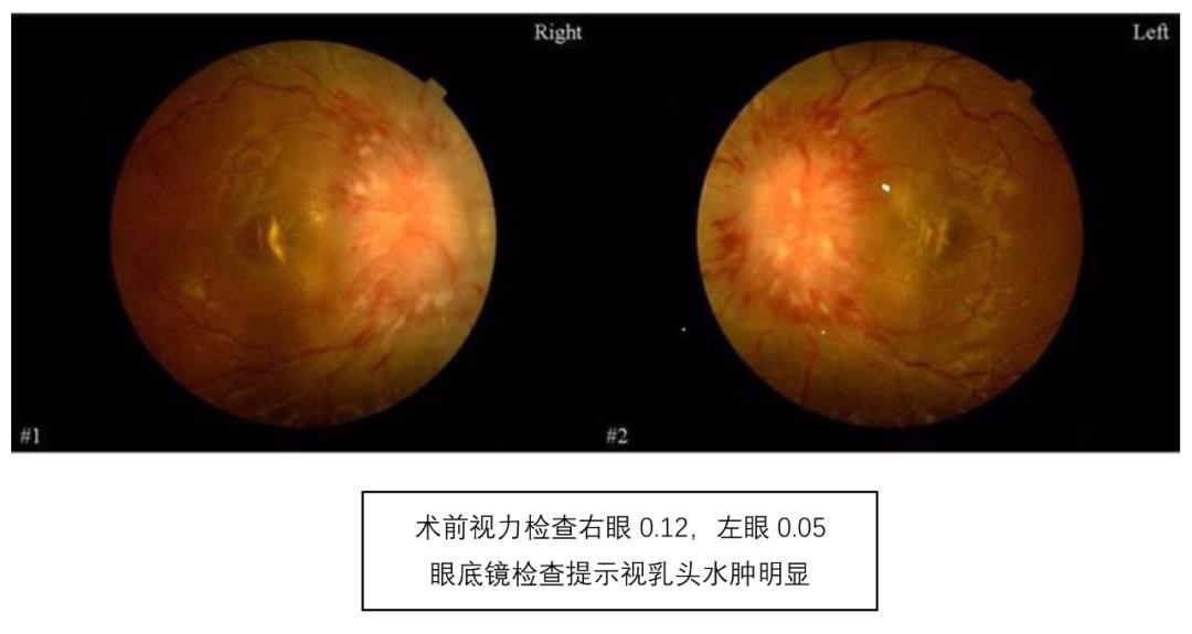 17岁女生头疼突然阶段性失明,19岁眼睛突然失明几分钟后恢复
