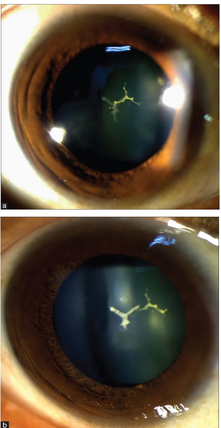 并发性白内障,暴发性白内障