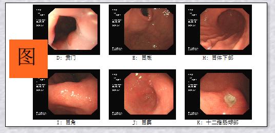 胃镜轻度肠化生到胃癌几年,胃炎肠化是怎么回事