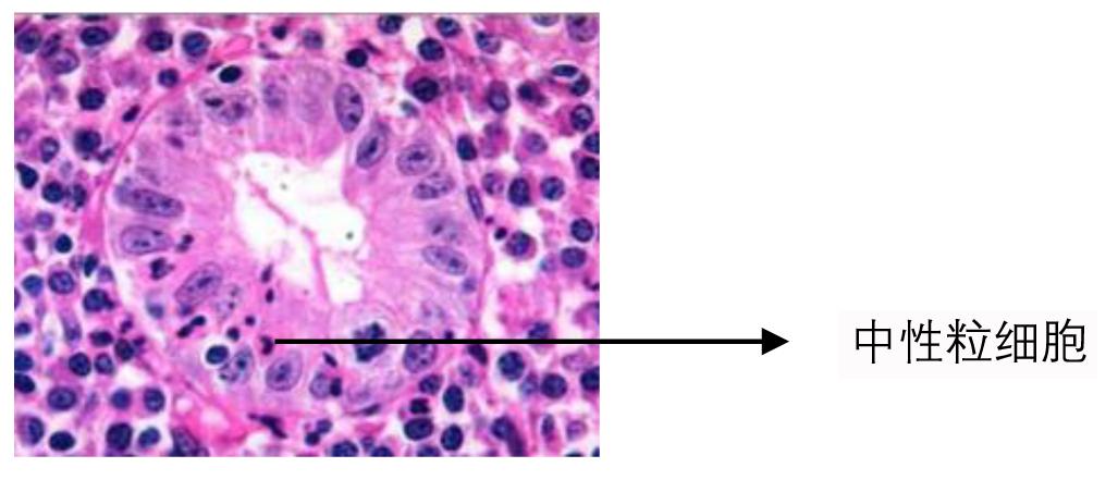 胃镜轻度肠化生到胃癌几年,胃炎肠化是怎么回事
