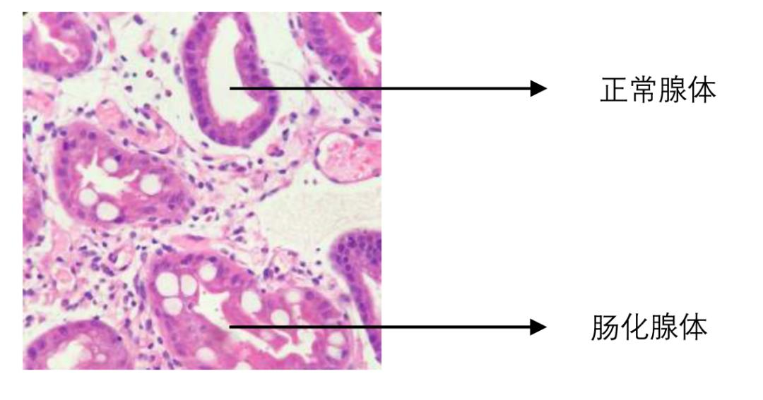 胃镜轻度肠化生到胃癌几年,胃炎肠化是怎么回事