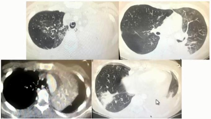 成人肺炎支原体肺炎诊治专家共识,2023肺炎支原体感染中药诊治指南