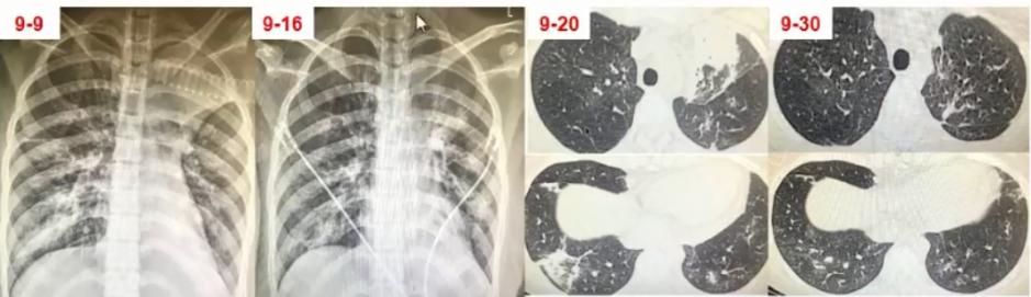 成人肺炎支原体肺炎诊治专家共识,2023肺炎支原体感染中药诊治指南