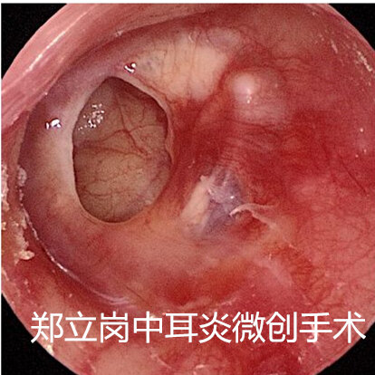 中耳炎耳内镜微创手术,内镜微创中耳炎