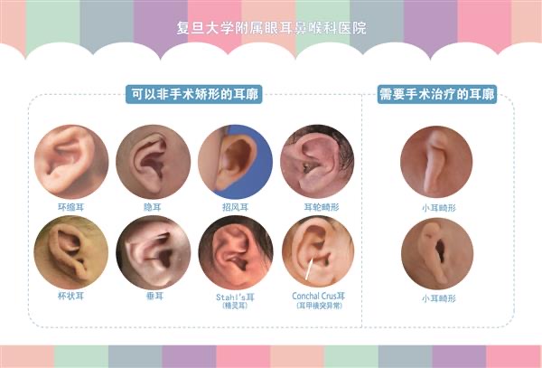 眼整形和近视眼手术能一起做吗,眼睛畸形整形恢复过程