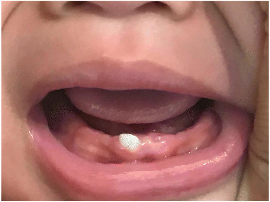 乳牙保存有什么用,乳牙掉了多久会长出恒牙