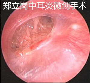 耳鼓膜穿孔一定要做手术吗,耳朵鼓膜穿孔手术费用多少