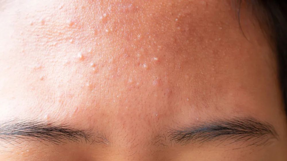 额头上反复长闭口怎么办,额头上都是小疙瘩闭口怎么消除