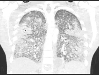 真菌感染是icu感染的第三大原因,真菌感染引起细菌感染