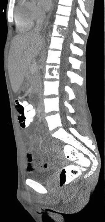 真菌感染是icu感染的第三大原因,真菌感染引起细菌感染