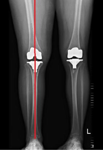 华西膝关节置换,华西医院人工关节置换