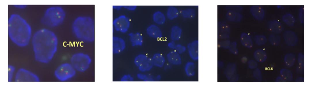 弥漫大b细胞淋巴瘤cd30阴性,cd30阳性淋巴瘤靶向药