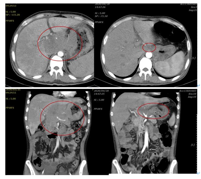 弥漫大b细胞淋巴瘤cd30阴性,cd30阳性淋巴瘤靶向药