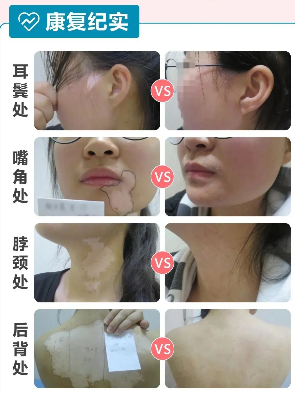 最新白癜风研究新药,白癜风临床试验招募2020